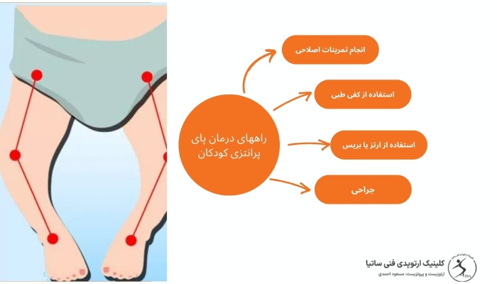 راههای درمان پای پرانتزی کودکان