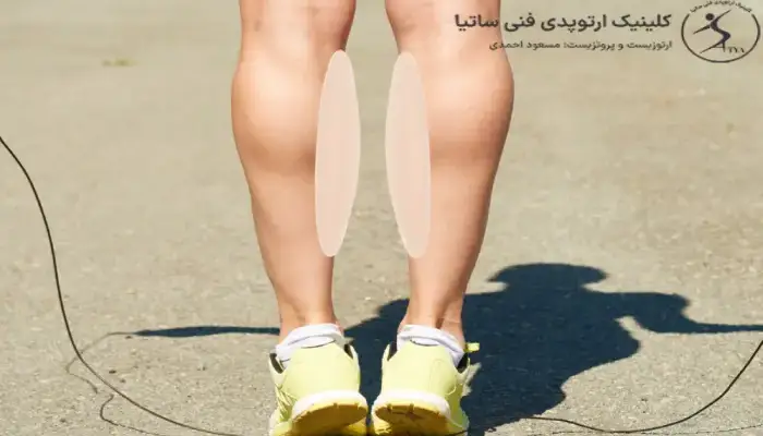 تاثیر حرکات اصلاحی پای پرانتزی کودکان