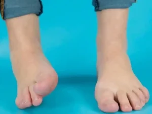 علت و درمان چرخش مچ پا کودک