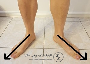 علت کج گذاشتن پا به سمت بیرون در بزرگسالان