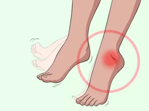 علائم و درمان افتادگی مچ پا یا فوت دراپ