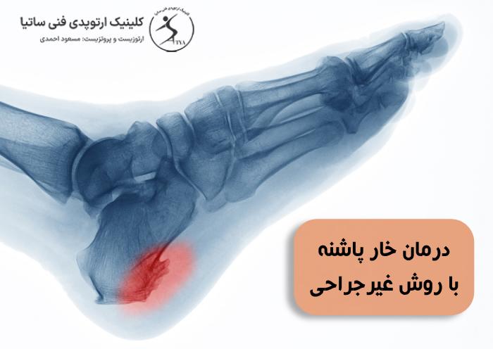 درمان خار پاشنه