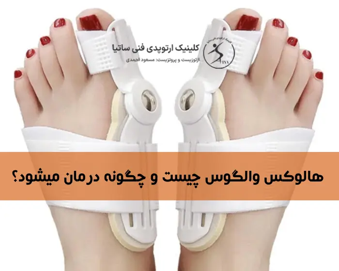 درمان هالوکس والگوس بدون جراحی