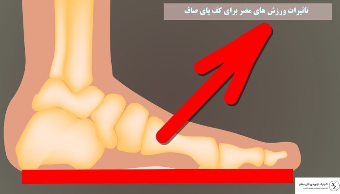 تاثیرات ورزش های مضر برای کف پای صاف
