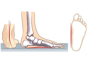عوارض کف پای صاف