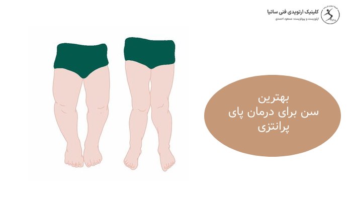 بهترین سن برای درمان پای پرانتزی چه سنی است؟