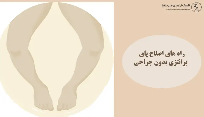 راه های اصلاح پای پرانتزی بدون جراحی