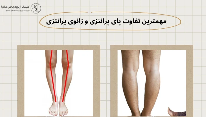 مهمترین تفاوت پای پرانتزی و زانوی پرانتزی