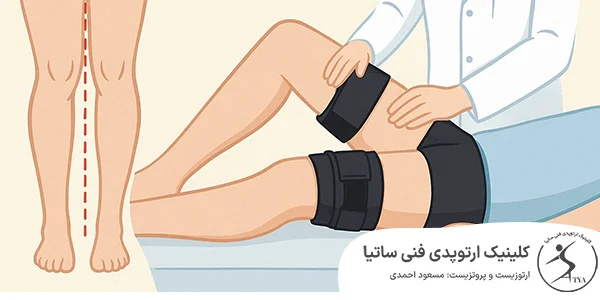 درمان زانو ضربدری در چالوس