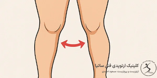 درمان زانوضربندری در ساتیا جالوس
