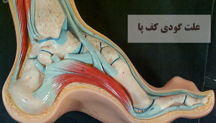 علت گودی کف پا