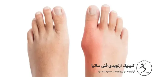 انحراف شست پا