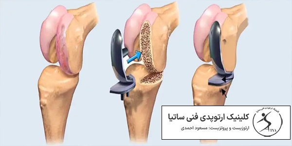 مراقبت های بعد از تعویض مفصل زانو