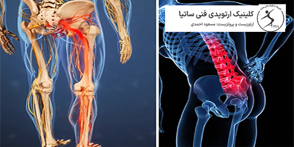 تفاوت دیسک کمر و سیاتیک