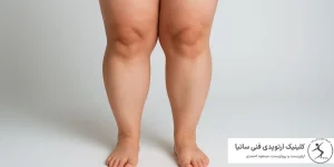 زانو ضربدری در کودکان