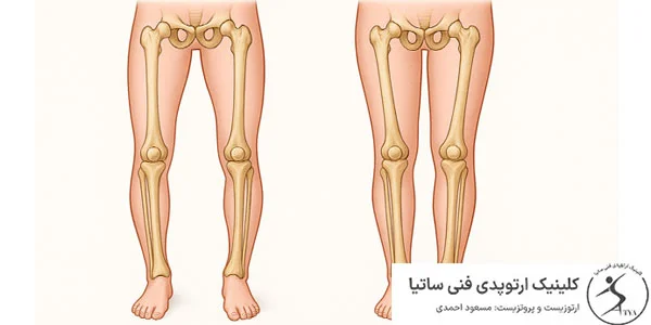 زانو ضربدری در کودکان چیست