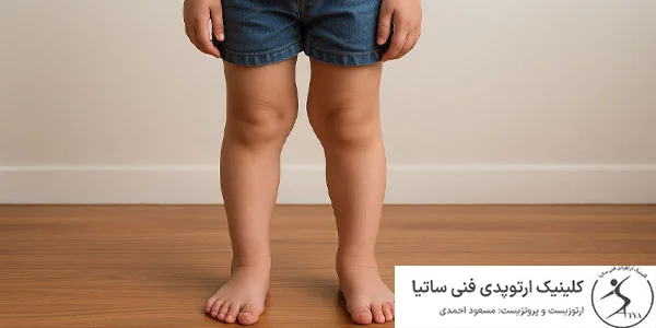 علت زانو ضبدری در کودکان