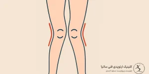عوارض زانو ضربدری پیامد ها