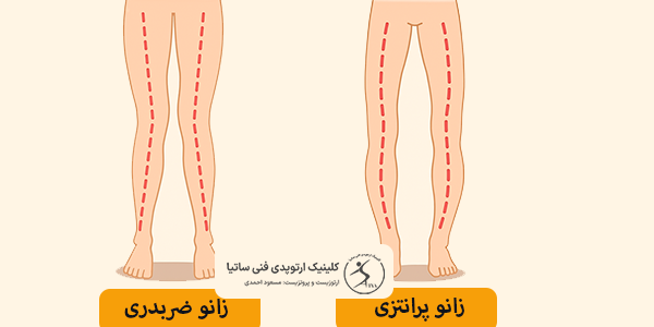 تفاوت زانو ضربدری با پرانتزی، در درمان چیست
