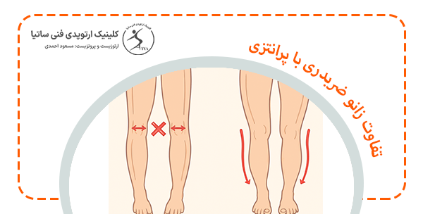 تفاوت زانو ضربدری با پرانتزی، چیست
